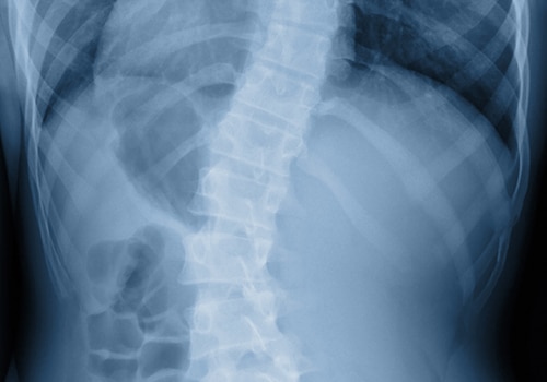 The Effects Of The 1918 Swine Flu On Chiropractic Care Scoliosis Chiropractic Care Kaysville Utah