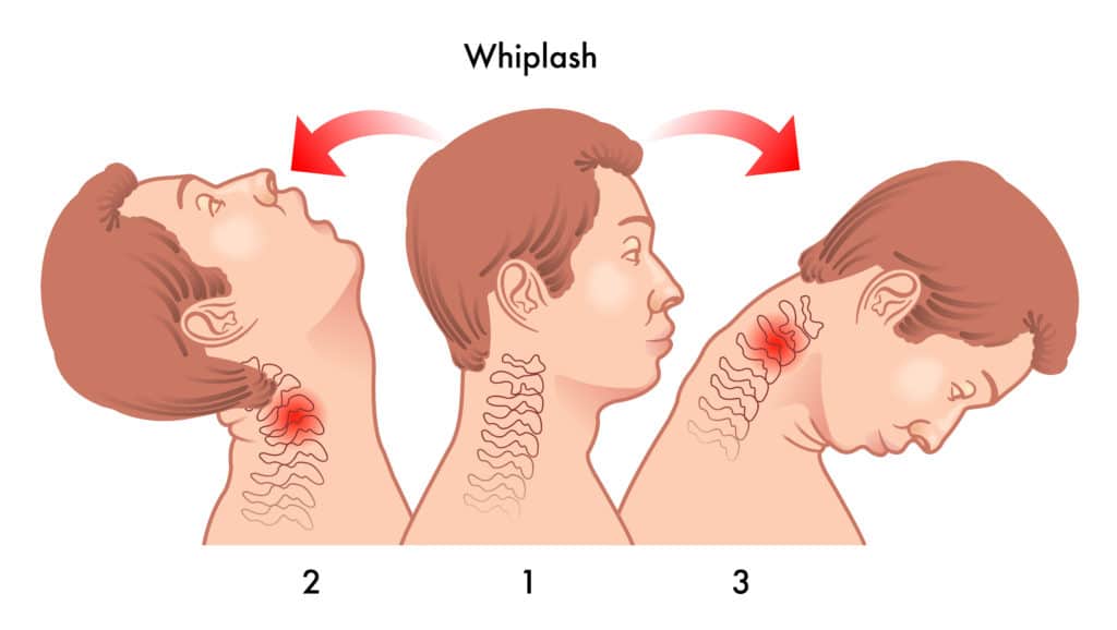 Whiplash Auto Injury Kaysville Utah