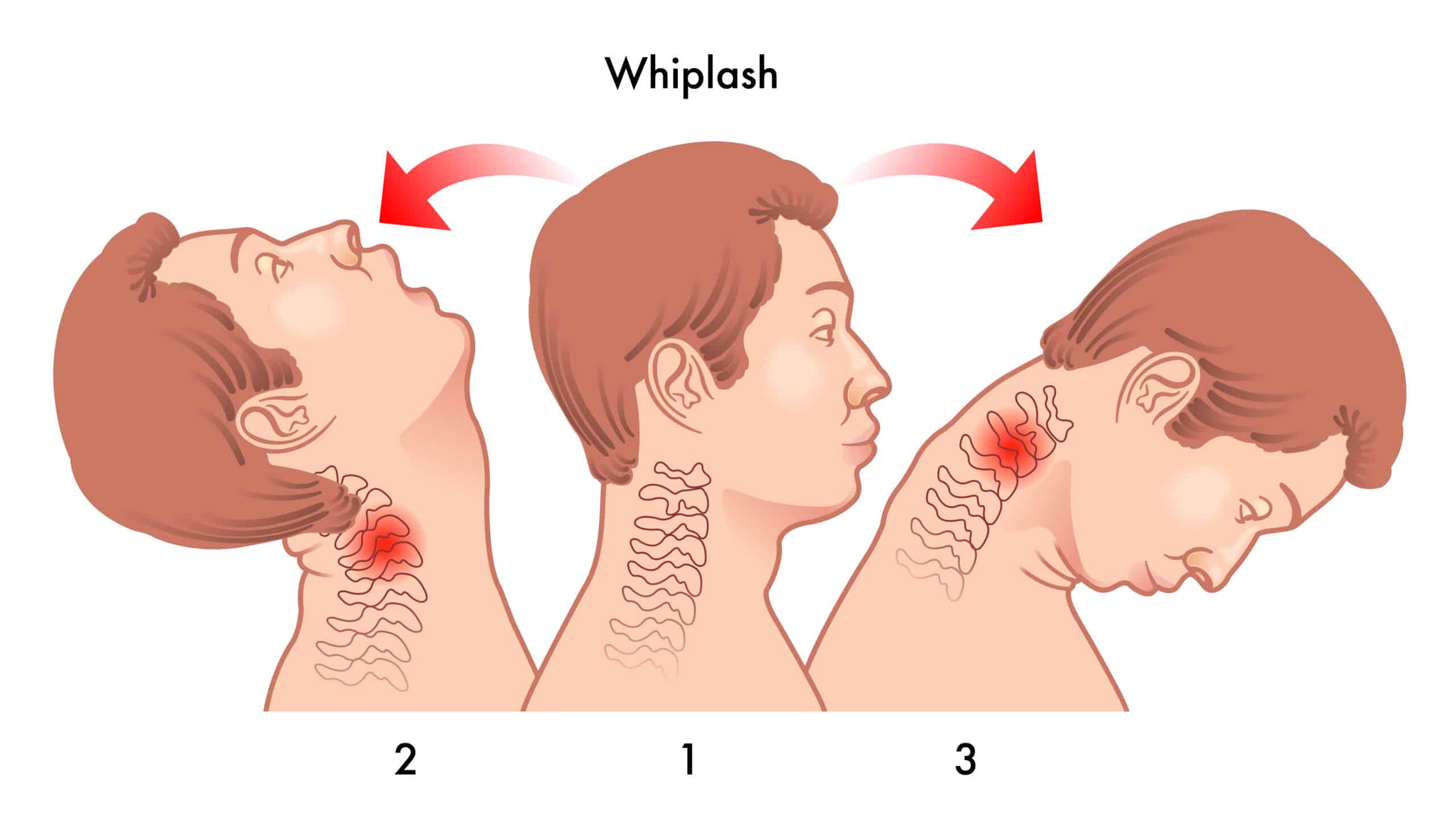 Whiplash And Why You Should Get Treated Whiplash Auto Injury Kaysville Utah