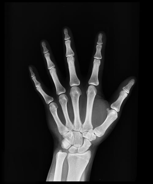 What Is Osteoporosis? Osteoporosis treatment kaysville utah