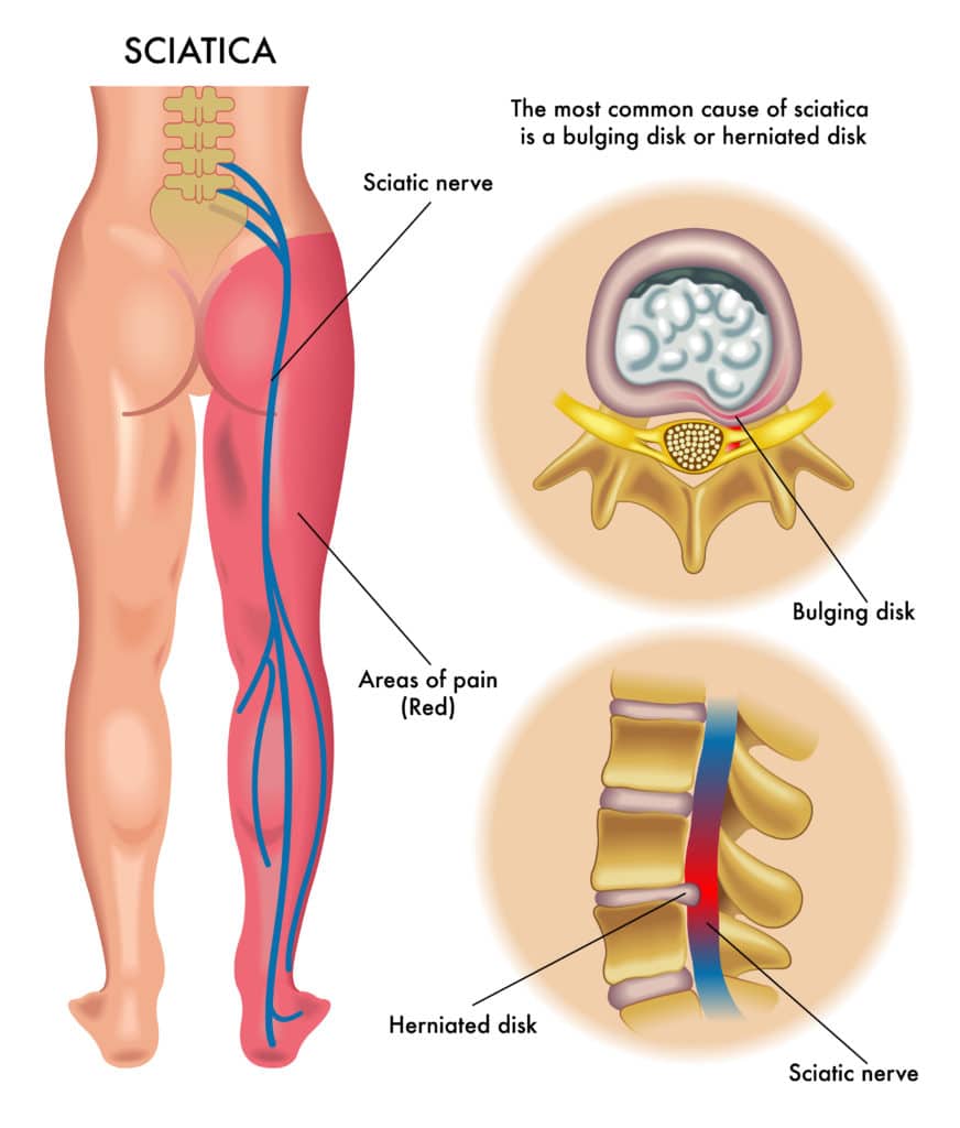 Sciatica information 