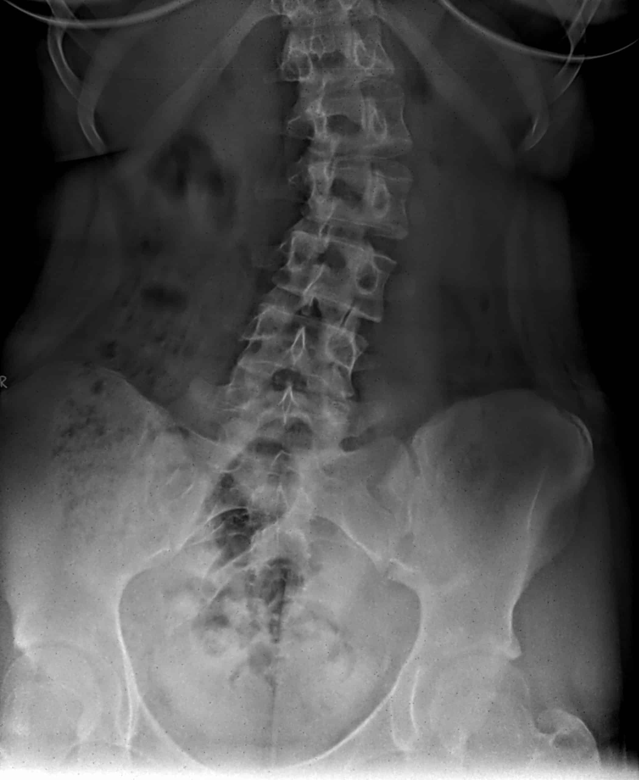 How Can Chiropractors Help Scoliosis?