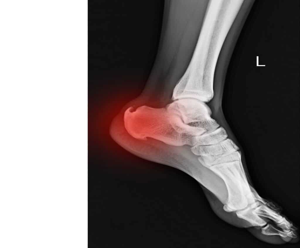 Gaining a Better Understanding of Bone Spurs
X-ray left foot showing Calcaneal spur on red color with copy space.