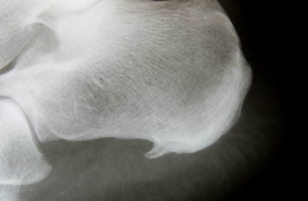 Gaining a Better Understanding of Bone Spurs
X-Ray image of heel with calcaneal spur (athlete´s foot syndrome, insertion tendopathy)