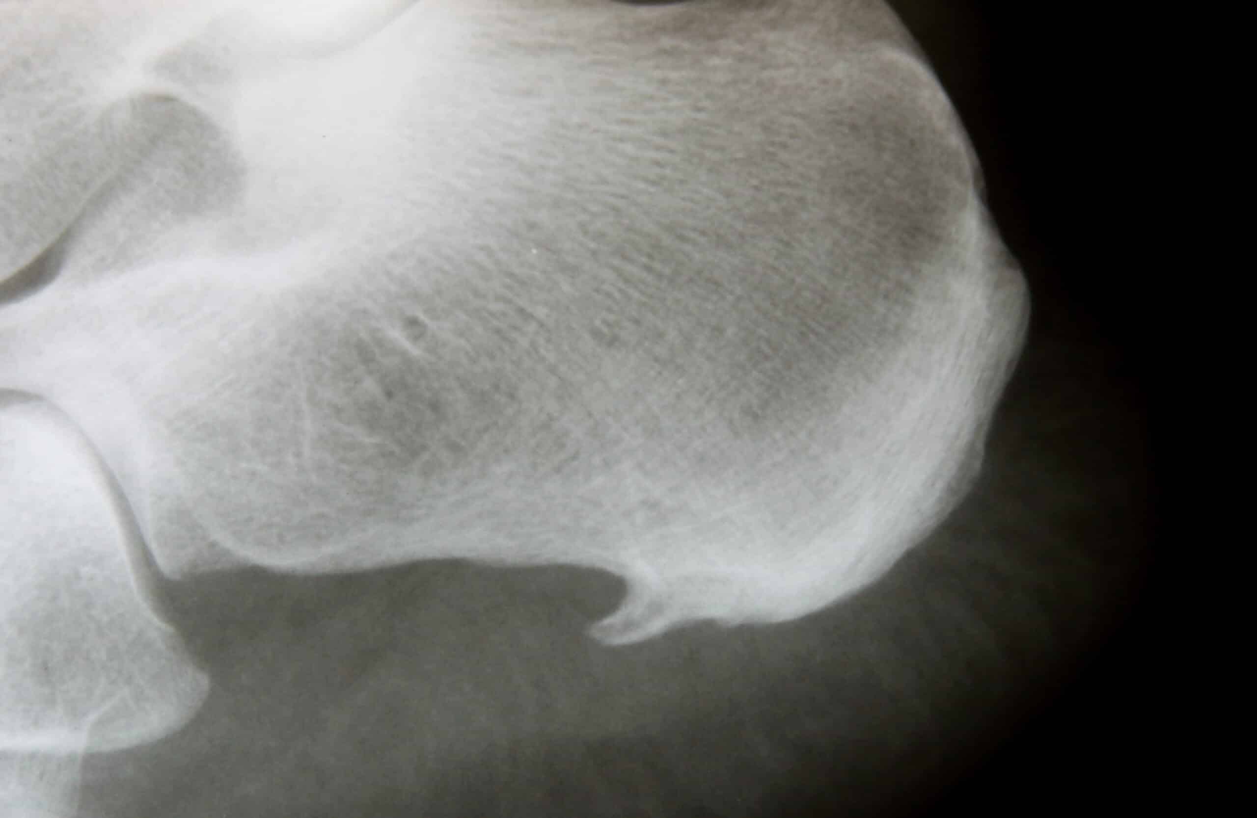 Bone Spurs X-Ray image of heel with calcaneal spur (athlete´s foot syndrome, insertion tendopathy)