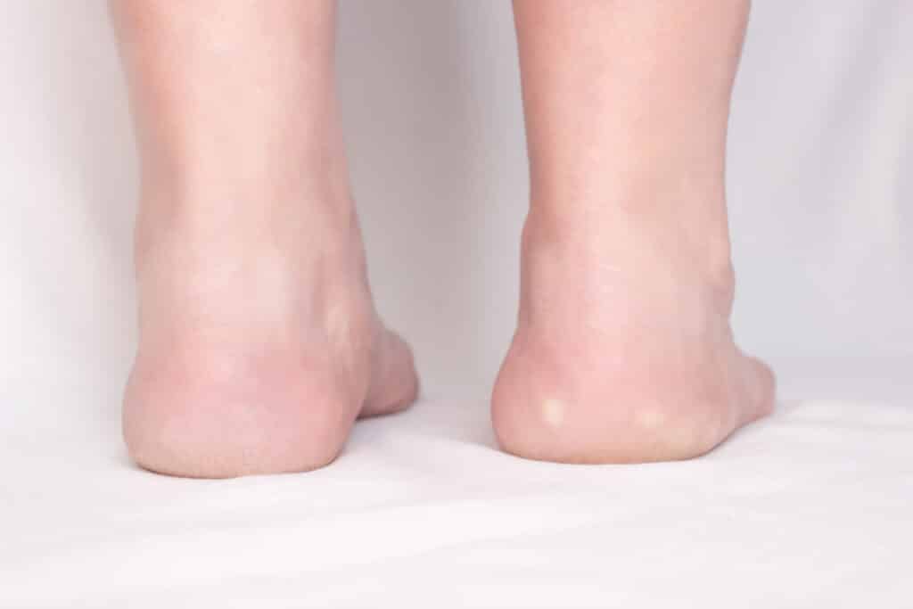Gaining a Better Understanding of Bone Spurs
Female feet with spots on a white background with heel spur disease, close-up, plantar fasciitis, osteophyte, inflammation